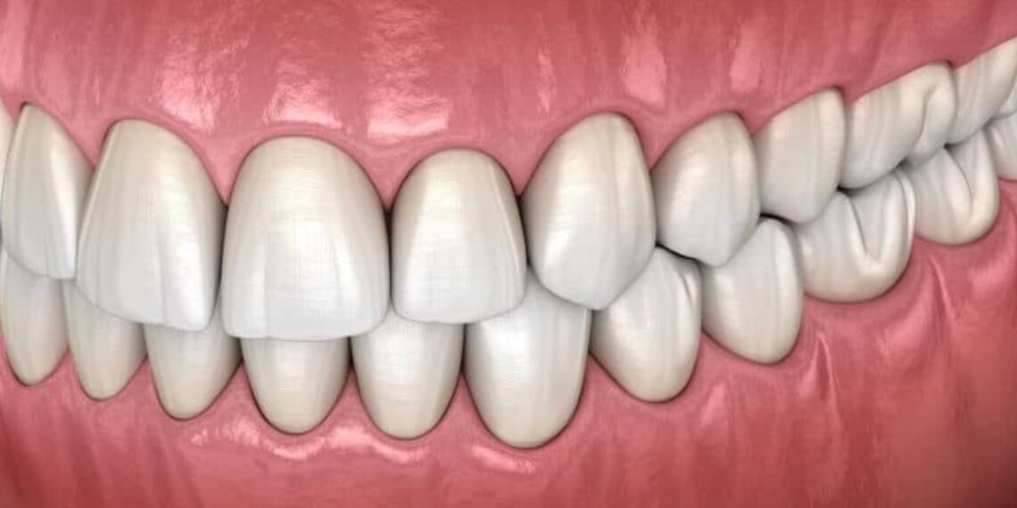 what is bite solgem z