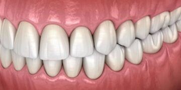 what is bite solgem z